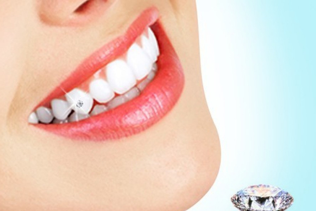Dịch vụ đính kim cương lên răng tặng kèm 01 lần Cạo vôi răng và Đánh bóng răng tại Nha khoa Việt
