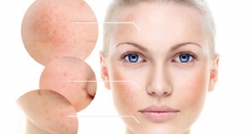 Khóa học trị nám hoặc trị mụn tại Đồng Cỏ Thiên Y