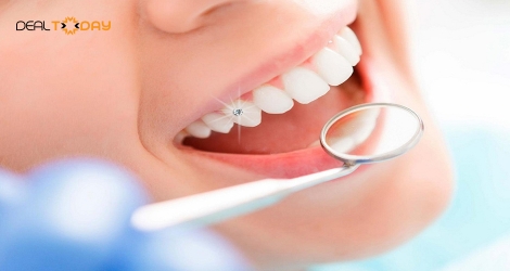 Làm đẹp răng đính đá kim cương thẩm mỹ tại Nha khoa Quốc tế Hoa Kỳ
