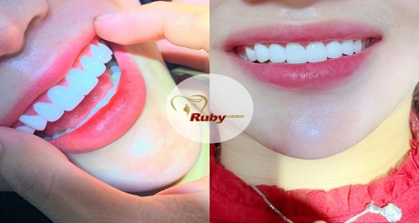 Bọc răng sứ Venus chuẩn Đức bảo hành 20 năm tại Nha Khoa Quốc tế Ruby Luxury