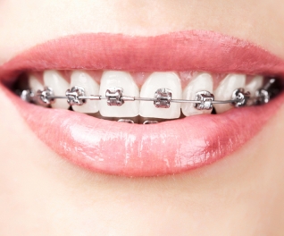 Nắn chỉnh răngNiềng răng toàn hàm mắc cài kim loại tại Nha Khoa Minh Châu bảo hành vĩnh viễn