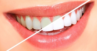 Lấy cao răng, đánh bóng và tư vấn vệ sinh răng miệng tại 360 Dental