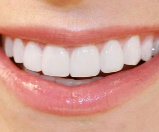 Nụ cười tỏa sáng với Dịch vụ Đính Kim cương lên răng tại Nha khoa Trí Huy