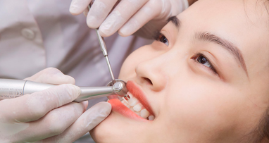 Khám răng miệng tổng quát lấy cao răng và đánh bóng trị viêm nướu tại Nha khoa HT