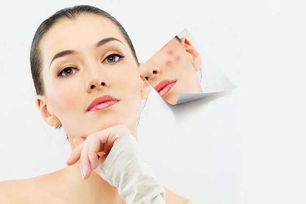 Trị mụn chuyên sâu tại Bellvian Spa