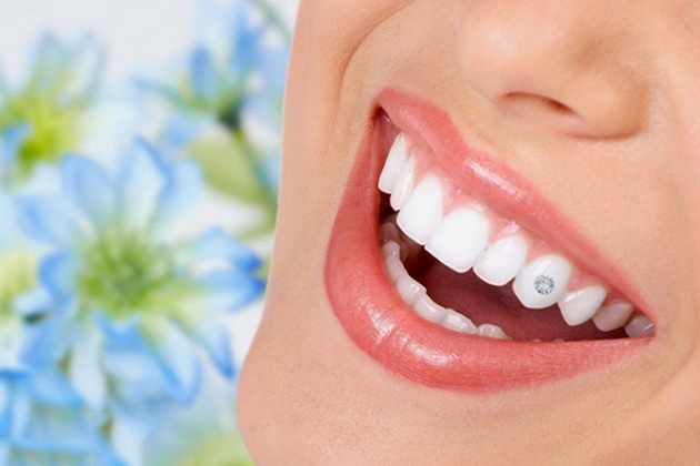 Dịch vụ đính kim cương lên răng tặng kèm 01 lần Cạo vôi răng và Đánh bóng răng tại Nha khoa Việt