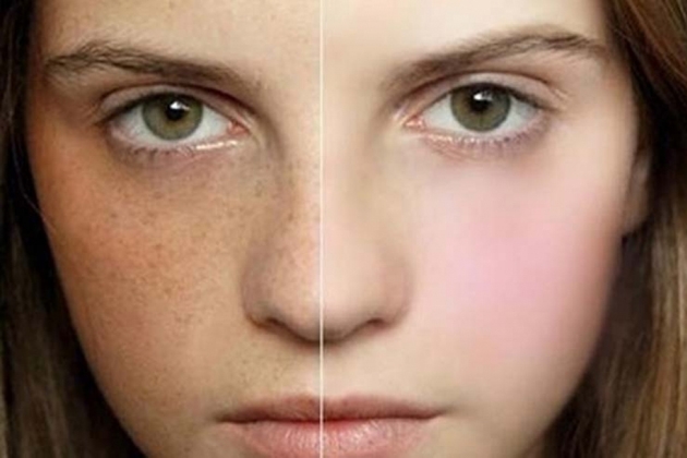 Trị nám bằng công nghệ Laser ND - YAG (01 lần) tại Les Sam Spa