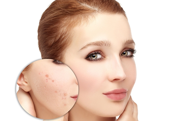 Điều trị mụn và phục hồi các loại da hư tổn nặng - 60 phút tại She’s Beauty Spa