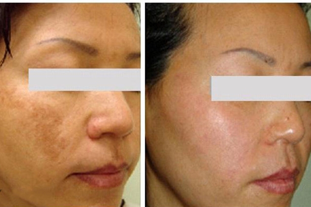 Điều trị mụn, sẹo tại thẩm mỹ Mai Anh