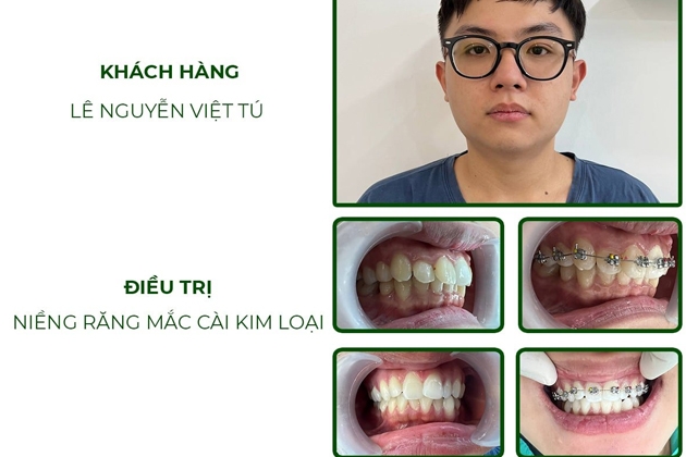 Voucher giảm giá trị giá 5 triệu áp dụng cho dịch vụ niềng răng ...